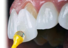 لمینیت دندان [object object] مراقبت های پس از درمان ریشه laminate Arasteh 260x185  مطالب دندانپزشکی laminate Arasteh 260x185