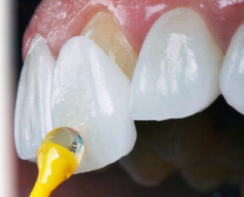 لمینیت دندان  لمینیت سرامیکی دندان دقیقا چه کاربردی دارد و چه مشکلاتی را برطرف می ‌کند؟ laminate Arasteh 495x400