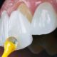 لمینیت دندان ایمپلنت دندان در شیراز درد در ایمپلنت دندان laminate Arasteh 80x80
