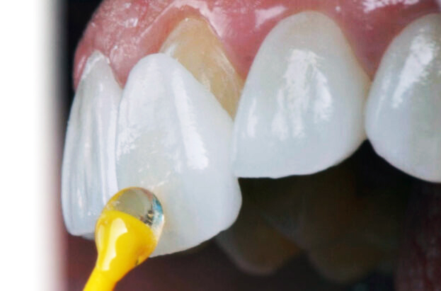 لمینیت دندان  لمینیت سرامیکی دندان دقیقا چه کاربردی دارد و چه مشکلاتی را برطرف می ‌کند؟ laminate Arasteh