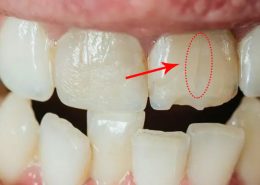 درمان ترک خوردگی دندان [object object] مراقبت های پس از درمان ریشه tarakdandan Arasteh 260x185  مطالب دندانپزشکی tarakdandan Arasteh 260x185
