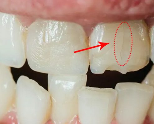 درمان ترک خوردگی دندان  چه کسانی به بیماری لثه مبتلا می شوند؟ tarakdandan Arasteh 495x400