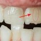 درمان ترک خوردگی دندان  چه دهانشویه ای انتخاب کنیم tarakdandan Arasteh 80x80