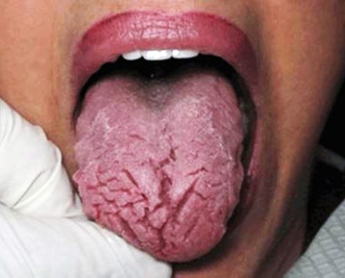 خشکی دهان  چه کسانی به بیماری لثه مبتلا می شوند؟ Xerostomia Arasteh 495x400
