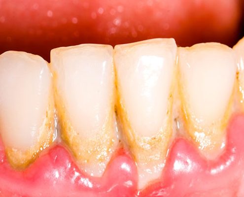 لکه های سفید روی دندان                                495x400