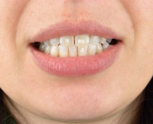 لکه های سفید روی دندان 0 2 495x400