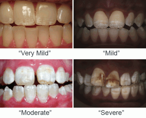 لکه های سفید روی دندان 2 495x400