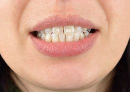 [object object] مراقبت های پس از درمان ریشه White spots 260x185  مطالب دندانپزشکی White spots 260x185