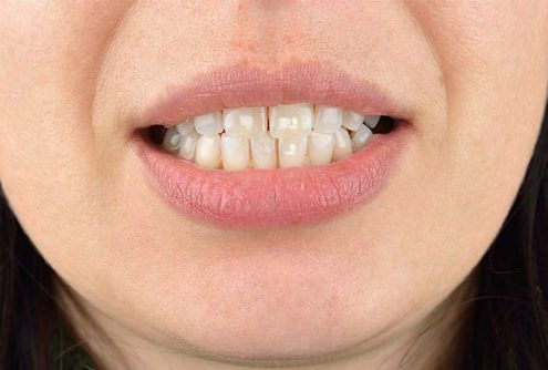 جلوگیری از شکستن دندان White spots 495x334