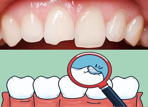 Types of tooth fractures  ترس از دندانپزشکی (دنتوفوبیا) چیست؟ broken1