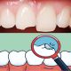 Types of tooth fractures  اثرات بی خوابی و نحوه خوابیدن بر سلامت دهان و دندان broken1