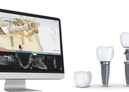 ایمپلنت دیجیتال [object object] مراقبت های پس از درمان ریشه Digital implant 260x185  مطالب دندانپزشکی Digital implant 260x185