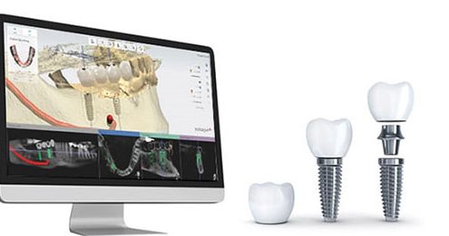 ایمپلنت دیجیتال  لکه های سفید روی دندان Digital implant 495x261