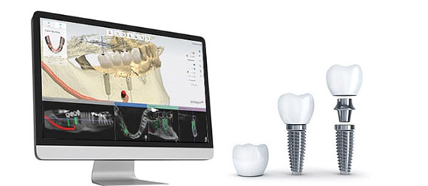 ایمپلنت دیجیتال  مزایای ایمپلنت دیجیتال Digital implant