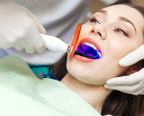کاربرد لیزر در دندانپزشکی  جلوگیری از شکستن دندان lasser 495x400