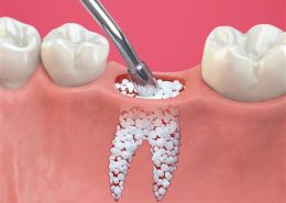 پودر استخوان [object object] مراقبت های پس از درمان ریشه bone graft 2 260x185  مطالب دندانپزشکی bone graft 2 260x185
