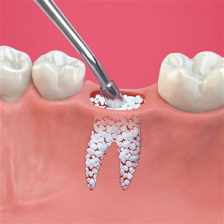 پودر استخوان  پودر استخوان در ایمپلنت دندان bone graft 2