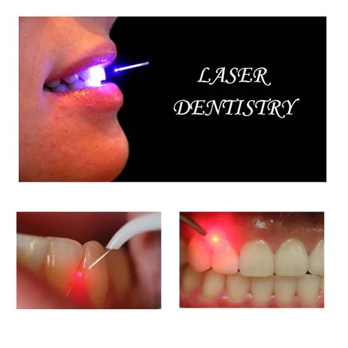 دندانپزشکی بدون درد چگونه است؟ laser dentistry