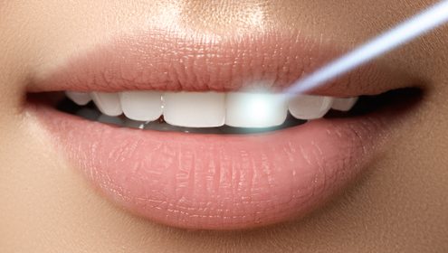 Laser denervation of teeth  لکه های سفید روی دندان shutterstock 364476872 495x280