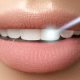 Laser denervation of teeth  کاشت نگین بر روی دندان shutterstock 364476872 80x80