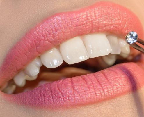 لکه های سفید روی دندان tooth gems 495x400