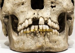 تاریخچه ایمپلنت [object object] مراقبت های پس از درمان ریشه history of dental implants 260x185  مطالب دندانپزشکی history of dental implants 260x185
