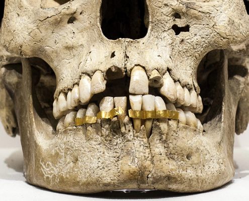 تاریخچه ایمپلنت  دندانپزشکی بدون درد چگونه است؟ history of dental implants 495x400