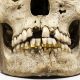 تاریخچه ایمپلنت  ایمپلنت مگاژن چیست؟ history of dental implants 80x80