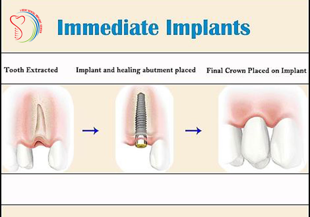 مراحل ایمپلنت فوری  ایمپلنت فوری immediate implant tooth