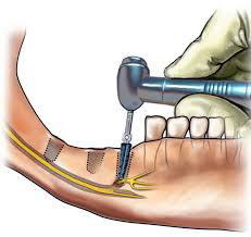 ضعیف بودن استخوان  علت سیاه شدن لثه بعد از ایمپلنت nerves dental implant