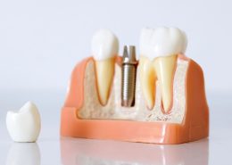 ایمپلنت فوری [object object] مراقبت های پس از درمان ریشه services implant dentistry 260x185  مطالب دندانپزشکی services implant dentistry 260x185