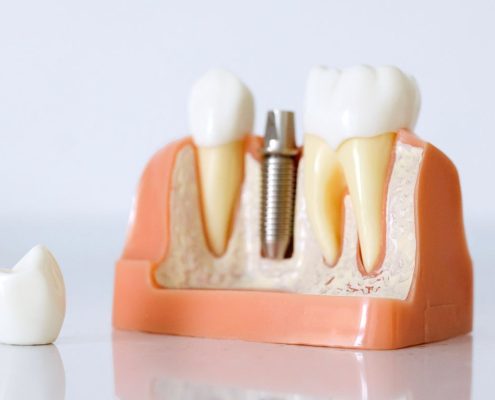ایمپلنت فوری  دندانپزشکی بدون درد چگونه است؟ services implant dentistry 495x400