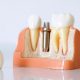 ایمپلنت فوری  دندانپزشکی پیشگیرانه services implant dentistry 80x80