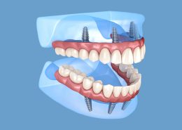 ایمپلنت all on 4 [object object] مراقبت های پس از درمان ریشه all on 4 dental implants 260x185  مطالب دندانپزشکی all on 4 dental implants 260x185