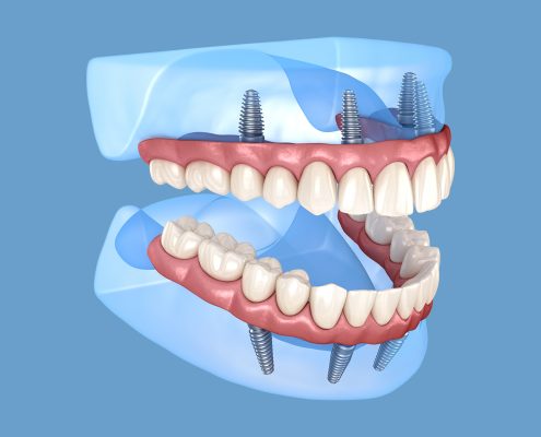 ایمپلنت all on 4  دندانپزشکی بدون درد چگونه است؟ all on 4 dental implants 495x400
