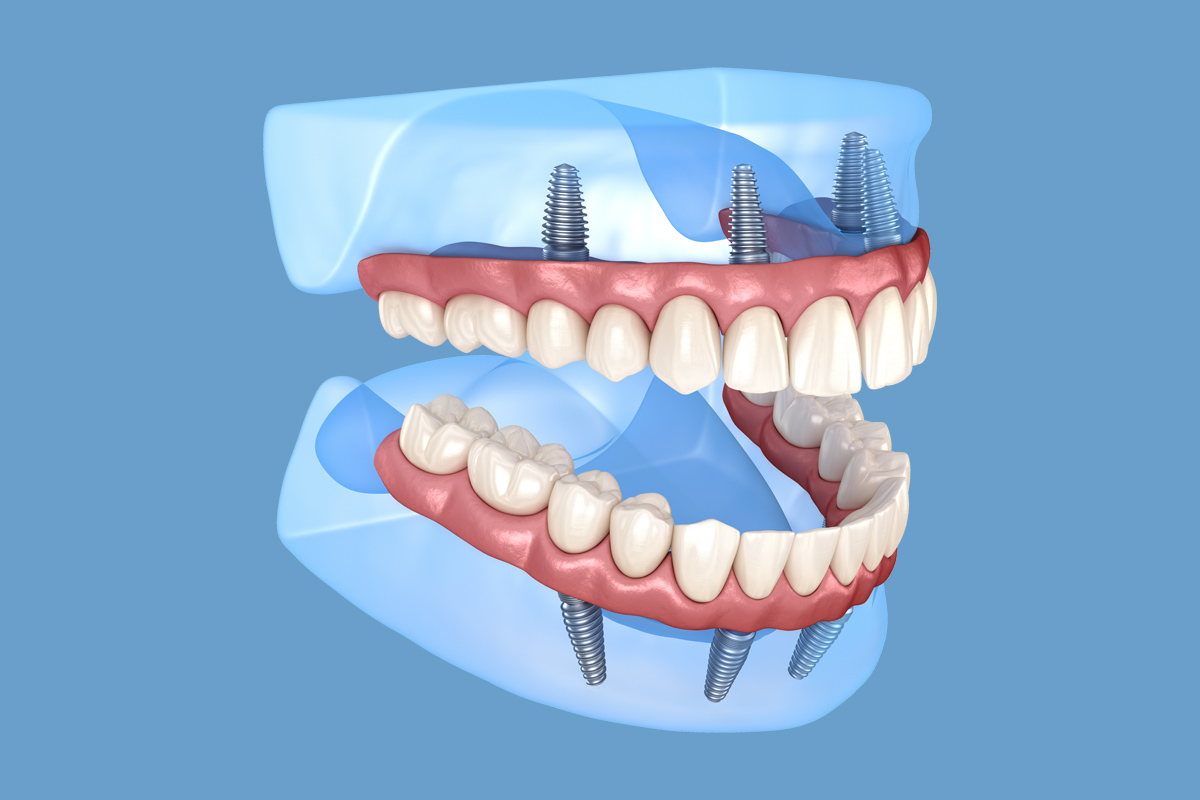 ایمپلنت all on 4  ایمپلنت ALL ON 4 all on 4 dental implants