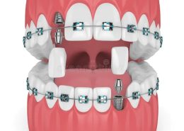 dental implants and orthodontics [object object] مراقبت های پس از درمان ریشه implants orthodontic 260x185  مطالب دندانپزشکی implants orthodontic 260x185
