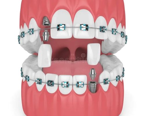 dental implants and orthodontics  دندانپزشکی بدون درد چگونه است؟ implants orthodontic 495x400