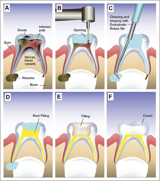 Milk tooth pulpotomy   Root canal treatment for child