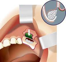 جراحی سینوس لیفت open sinus