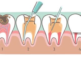 Milk tooth pulpotomy [object object] مراقبت های پس از درمان ریشه root canal 260x185  مطالب دندانپزشکی root canal 260x185