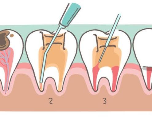 Milk tooth pulpotomy  انواع برندهای ایمپلنت root canal 495x390