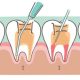 Milk tooth pulpotomy  اس اس کرون چیست؟ root canal 80x80