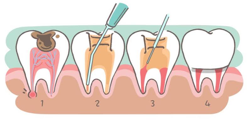 Milk tooth pulpotomy   root canal