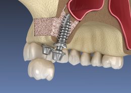 جراحی سینوس [object object] مراقبت های پس از درمان ریشه sinus lift surgery 260x185  مطالب دندانپزشکی sinus lift surgery 260x185