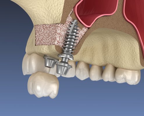 جراحی سینوس  اورد نچر چیست و چه تفاوتی با دندان مصنوعی دارد؟ sinus lift surgery 495x400