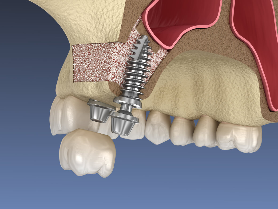 جراحی سینوس  جراحی سینوس لیفت sinus lift surgery