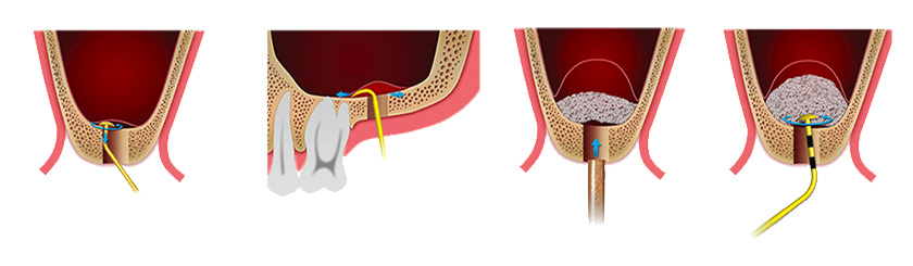 جراحی سینوس لیفت sinus lifting smile