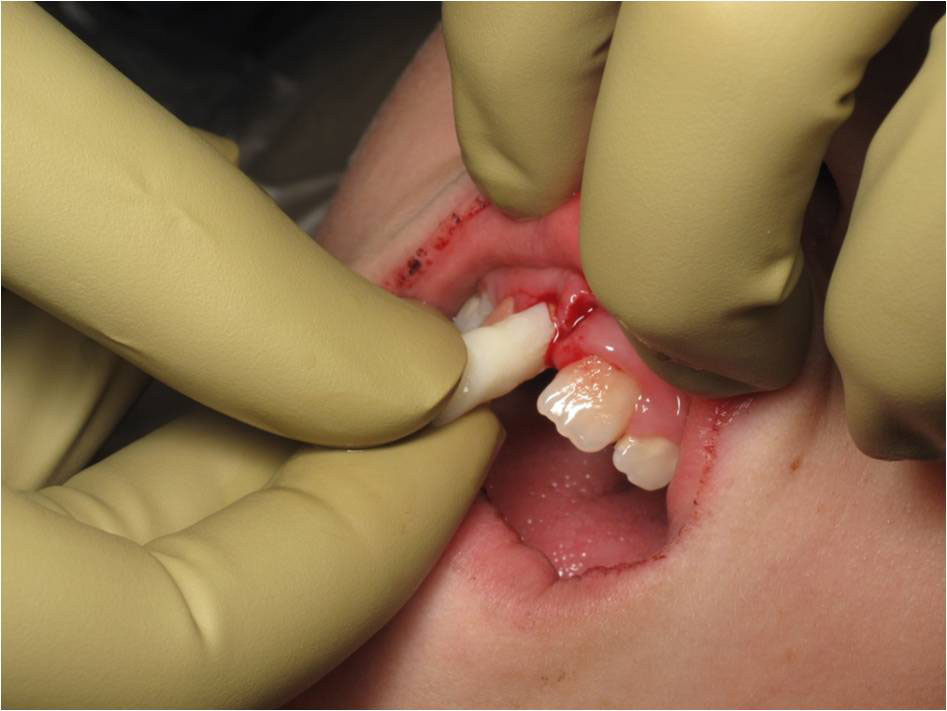 انواع آسیب های دندان کودکان 120321 F RG433 001
