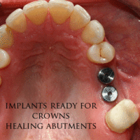 Implant without surgery   Dental implant